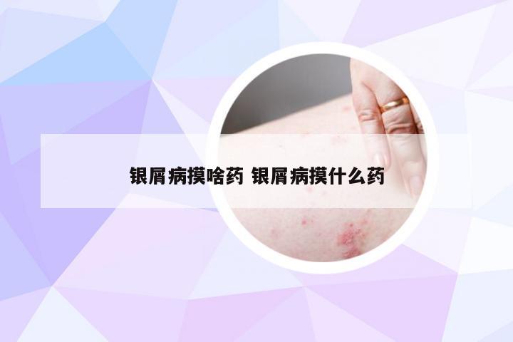 银屑病摸啥药 银屑病摸什么药