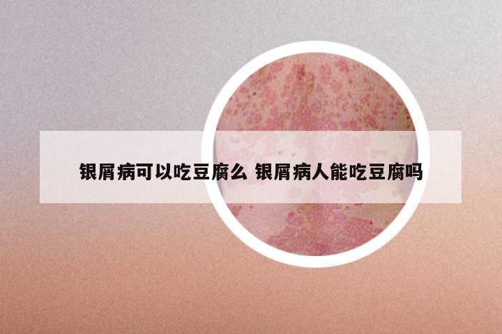 银屑病可以吃豆腐么 银屑病人能吃豆腐吗