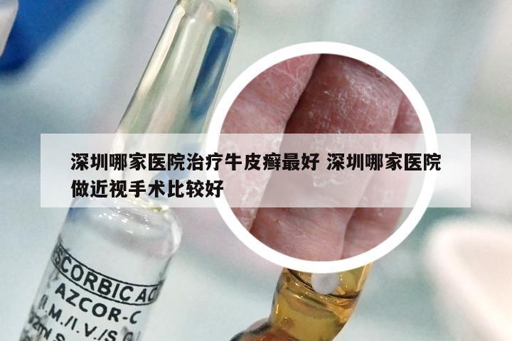 深圳哪家医院治疗牛皮癣最好 深圳哪家医院做近视手术比较好