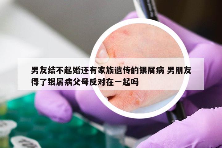 男友结不起婚还有家族遗传的银屑病 男朋友得了银屑病父母反对在一起吗