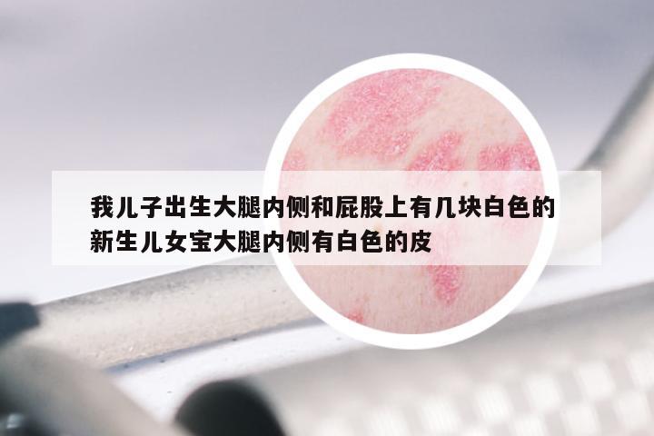 我儿子出生大腿内侧和屁股上有几块白色的 新生儿女宝大腿内侧有白色的皮