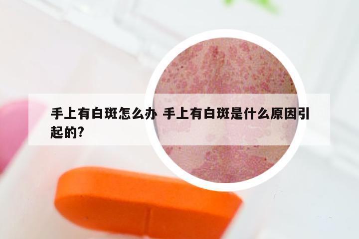 手上有白斑怎么办 手上有白斑是什么原因引起的?