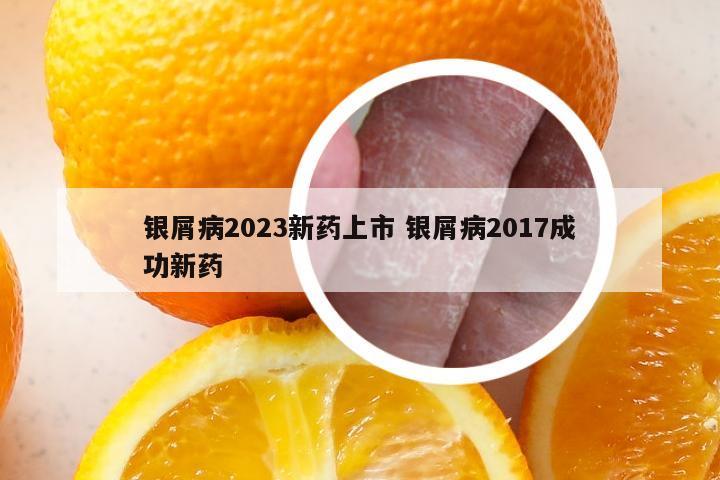 银屑病2023新药上市 银屑病2017成功新药