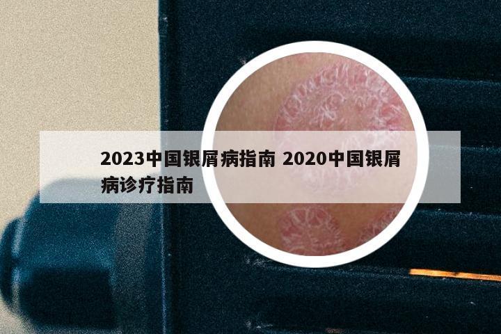 2023中国银屑病指南 2020中国银屑病诊疗指南