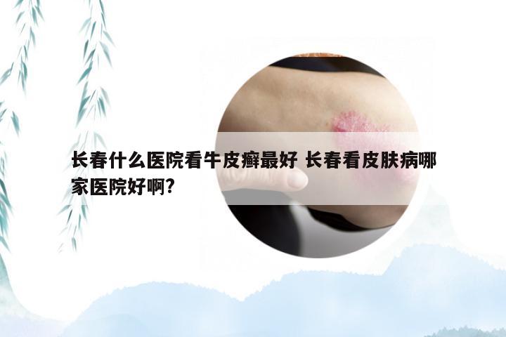 长春什么医院看牛皮癣最好 长春看皮肤病哪家医院好啊?