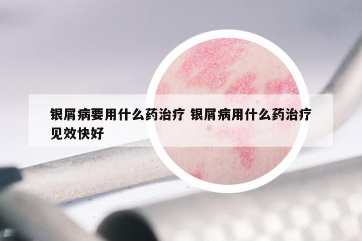 银屑病要用什么药治疗 银屑病用什么药治疗见效快好