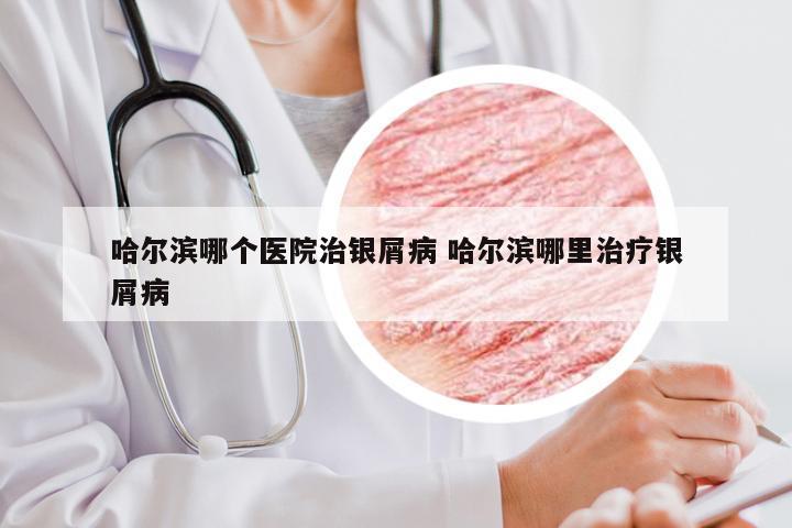 哈尔滨哪个医院治银屑病 哈尔滨哪里治疗银屑病