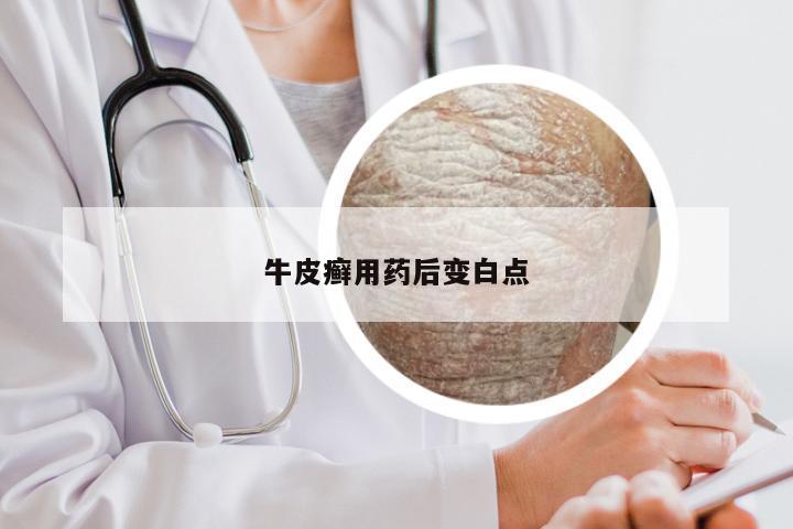 牛皮癣用药后变白点