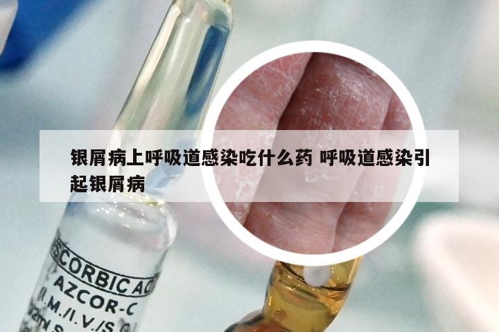 银屑病上呼吸道感染吃什么药 呼吸道感染引起银屑病