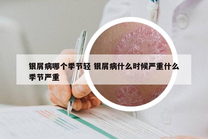 银屑病哪个季节轻 银屑病什么时候严重什么季节严重