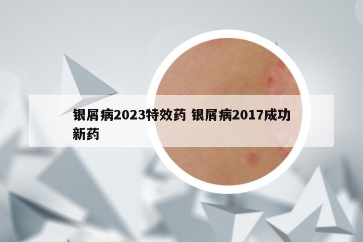 银屑病2023特效药 银屑病2017成功新药