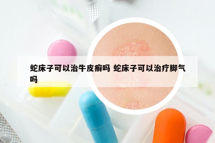 蛇床子可以治牛皮癣吗 蛇床子可以治疗脚气吗