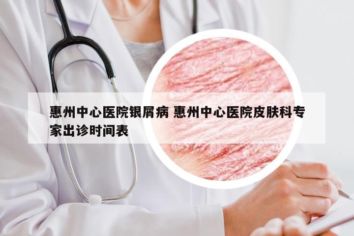 惠州中心医院银屑病 惠州中心医院皮肤科专家出诊时间表