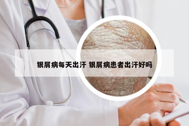 银屑病每天出汗 银屑病患者出汗好吗