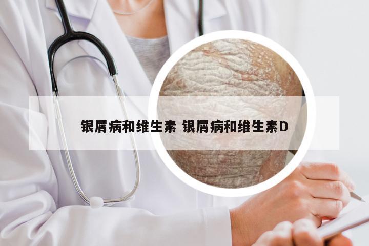 银屑病和维生素 银屑病和维生素D