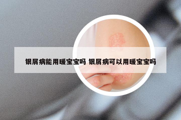 银屑病能用暖宝宝吗 银屑病可以用暖宝宝吗