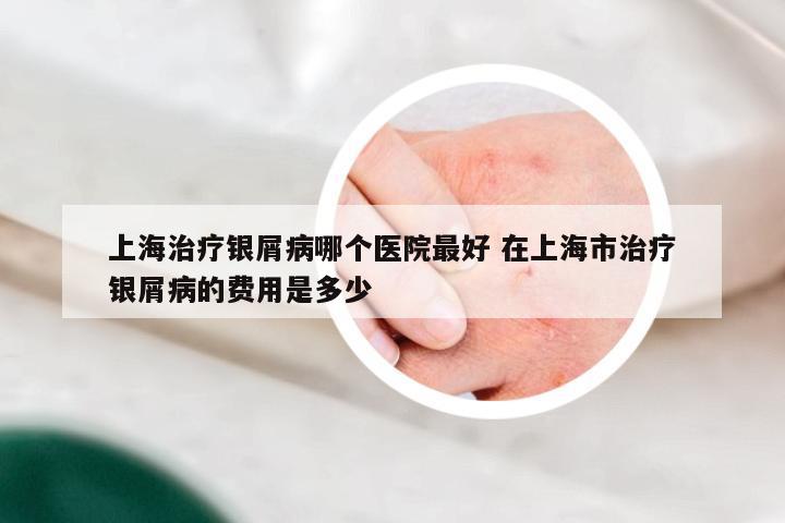 上海治疗银屑病哪个医院最好 在上海市治疗银屑病的费用是多少