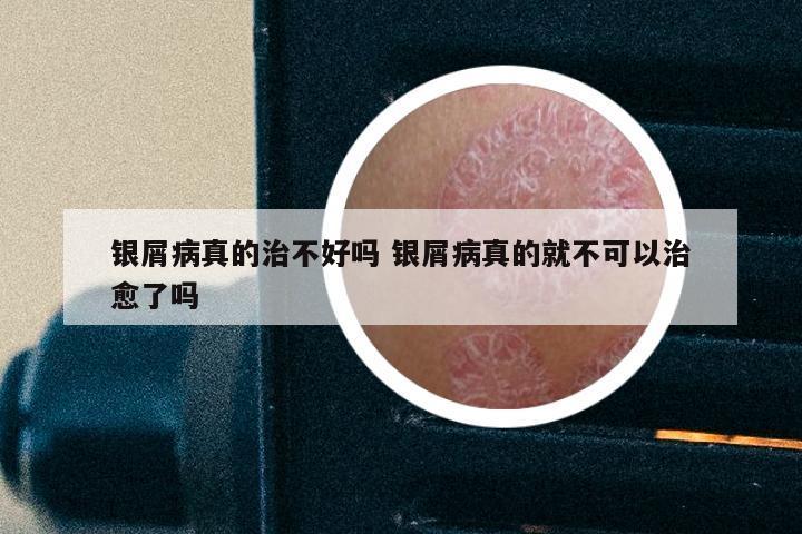 银屑病真的治不好吗 银屑病真的就不可以治愈了吗