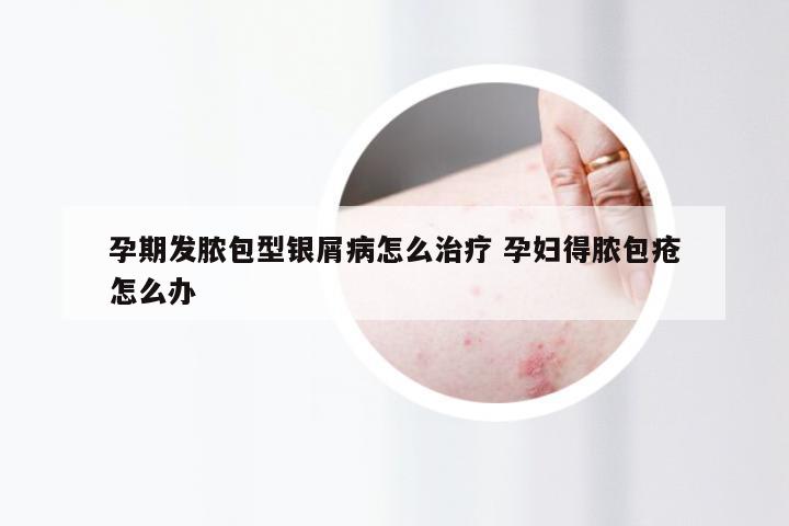 孕期发脓包型银屑病怎么治疗 孕妇得脓包疮怎么办