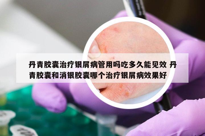 丹青胶囊治疗银屑病管用吗吃多久能见效 丹青胶囊和消银胶囊哪个治疗银屑病效果好