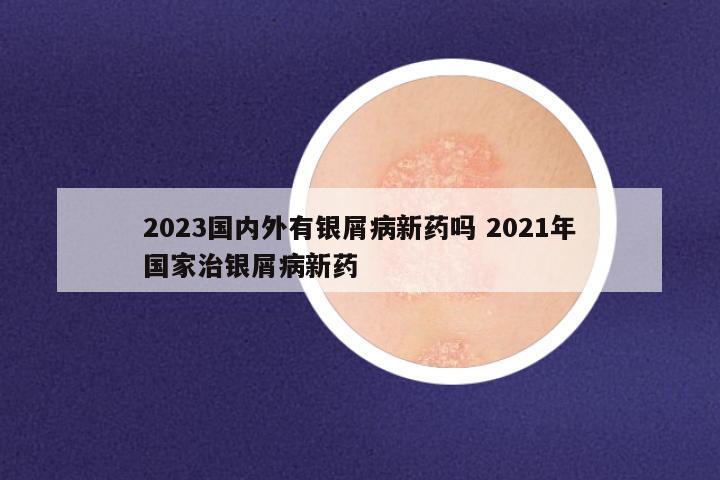 2023国内外有银屑病新药吗 2021年国家治银屑病新药