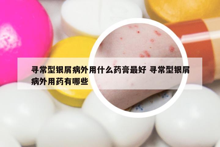 寻常型银屑病外用什么药膏最好 寻常型银屑病外用药有哪些