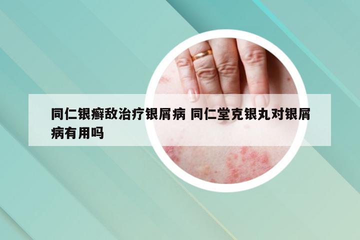 同仁银癣敌治疗银屑病 同仁堂克银丸对银屑病有用吗