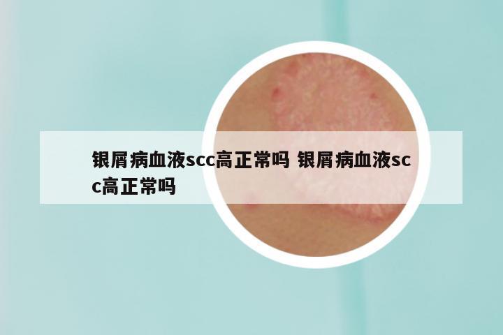 银屑病血液scc高正常吗 银屑病血液scc高正常吗