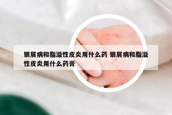 银屑病和脂溢性皮炎用什么药 银屑病和脂溢性皮炎用什么药膏