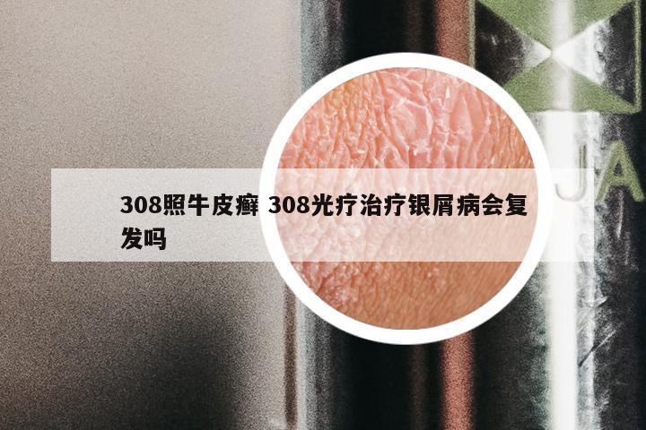 308照牛皮癣 308光疗治疗银屑病会复发吗