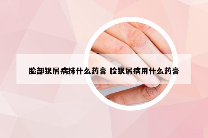 脸部银屑病抹什么药膏 脸银屑病用什么药膏