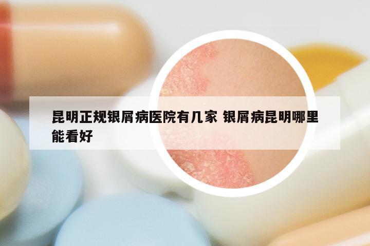 昆明正规银屑病医院有几家 银屑病昆明哪里能看好