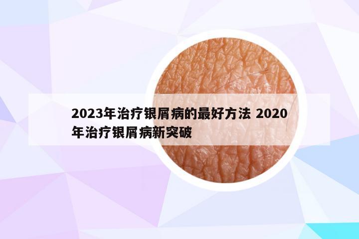 2023年治疗银屑病的最好方法 2020年治疗银屑病新突破