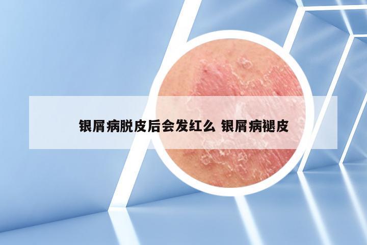 银屑病脱皮后会发红么 银屑病褪皮