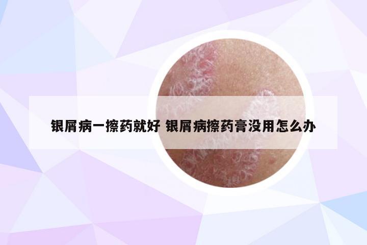 银屑病一擦药就好 银屑病擦药膏没用怎么办