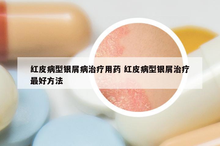 红皮病型银屑病治疗用药 红皮病型银屑治疗最好方法