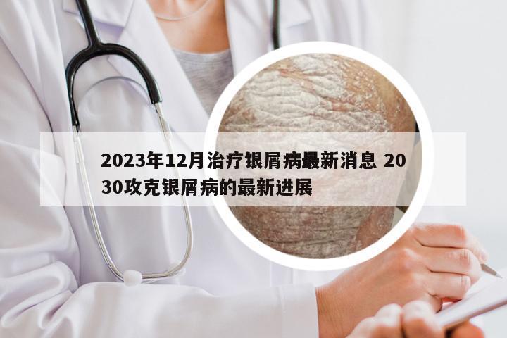 2023年12月治疗银屑病最新消息 2030攻克银屑病的最新进展