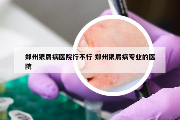 郑州银屑病医院行不行 郑州银屑病专业的医院