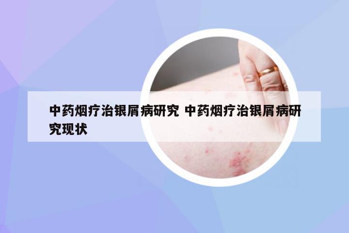 中药烟疗治银屑病研究 中药烟疗治银屑病研究现状