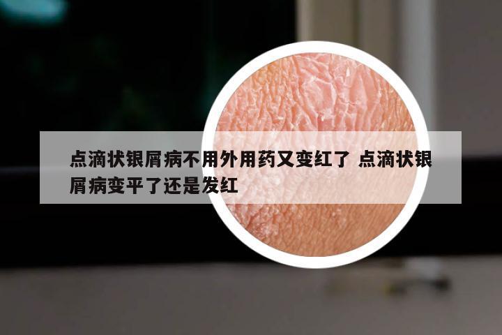 点滴状银屑病不用外用药又变红了 点滴状银屑病变平了还是发红