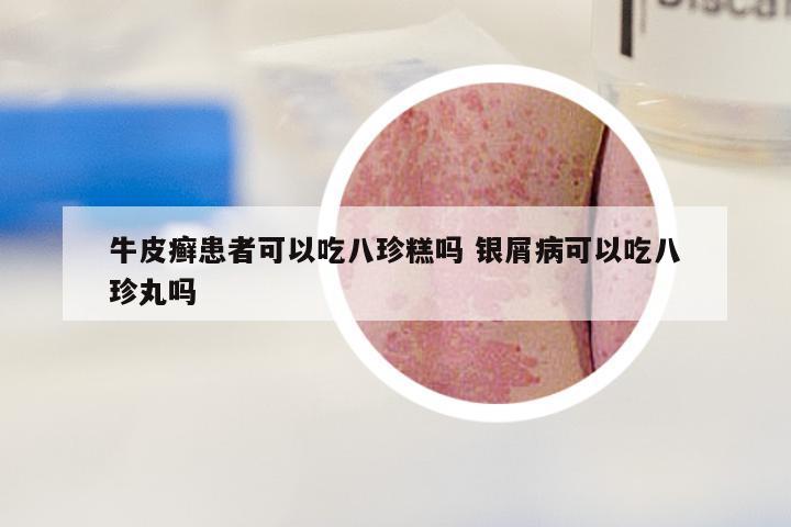 牛皮癣患者可以吃八珍糕吗 银屑病可以吃八珍丸吗