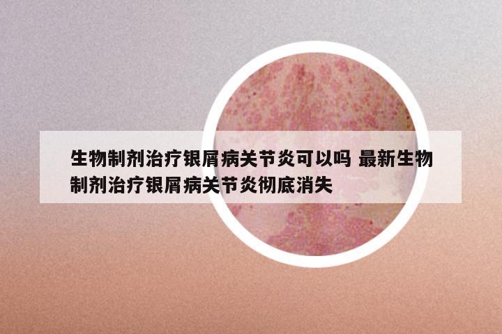 生物制剂治疗银屑病关节炎可以吗 最新生物制剂治疗银屑病关节炎彻底消失