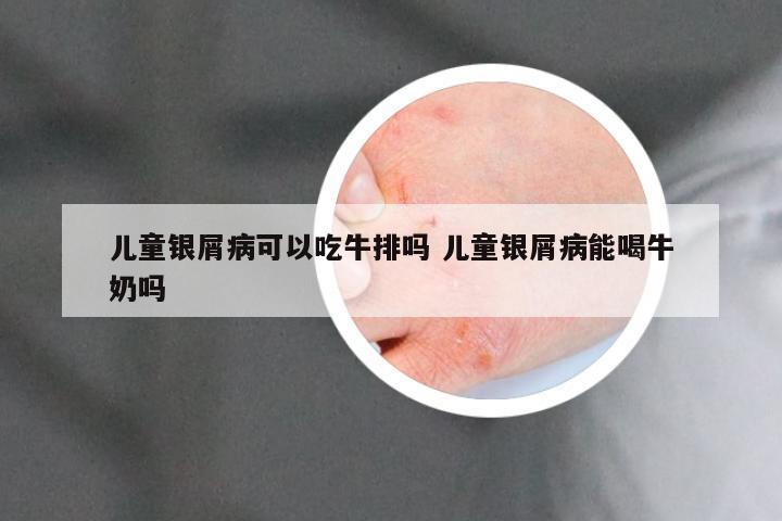 儿童银屑病可以吃牛排吗 儿童银屑病能喝牛奶吗