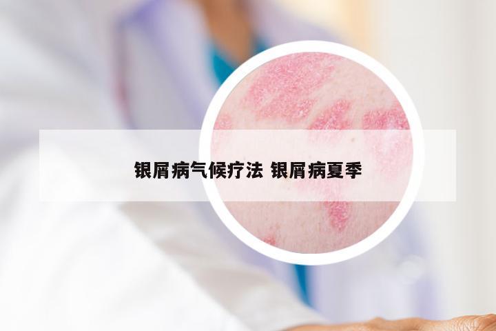 银屑病气候疗法 银屑病夏季