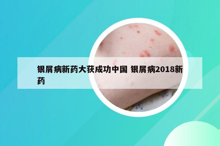 银屑病新药大获成功中国 银屑病2018新药