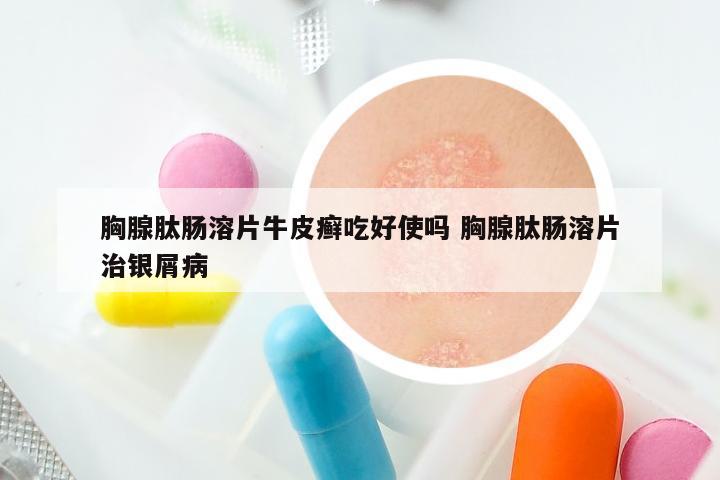 胸腺肽肠溶片牛皮癣吃好使吗 胸腺肽肠溶片治银屑病