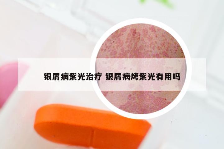 银屑病紫光治疗 银屑病烤紫光有用吗