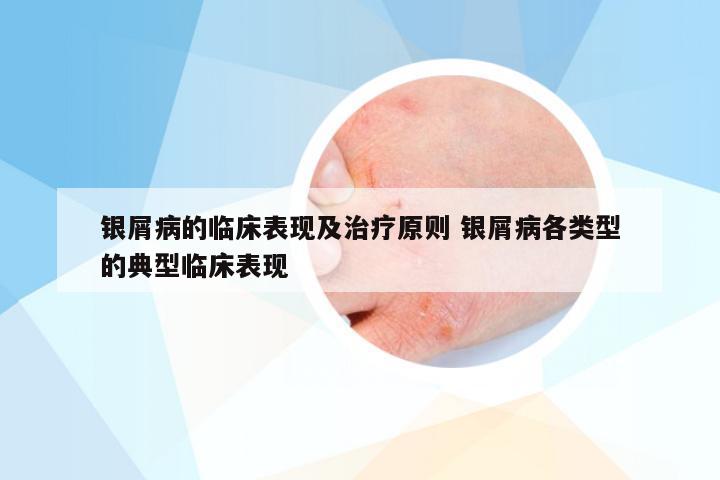 银屑病的临床表现及治疗原则 银屑病各类型的典型临床表现