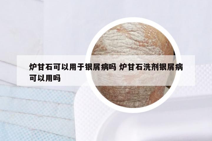 炉甘石可以用于银屑病吗 炉甘石洗剂银屑病可以用吗