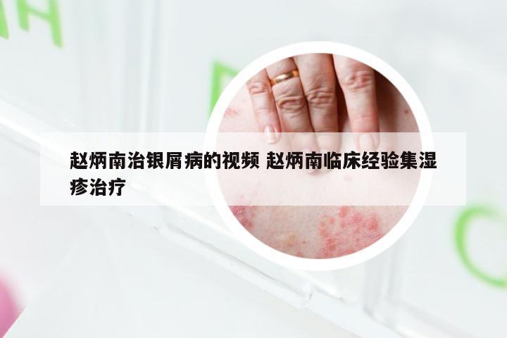 赵炳南治银屑病的视频 赵炳南临床经验集湿疹治疗